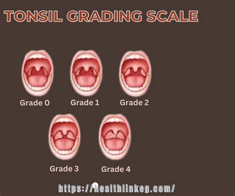 The Big Value From Using Tonsil Grading Scale | The Scale In 2024 ...