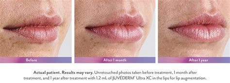 Juvederm - Vitality Anti-Aging Center