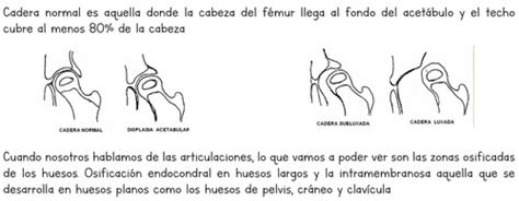 Fichas De Aprendizaje Displasia De Cadera Quizlet
