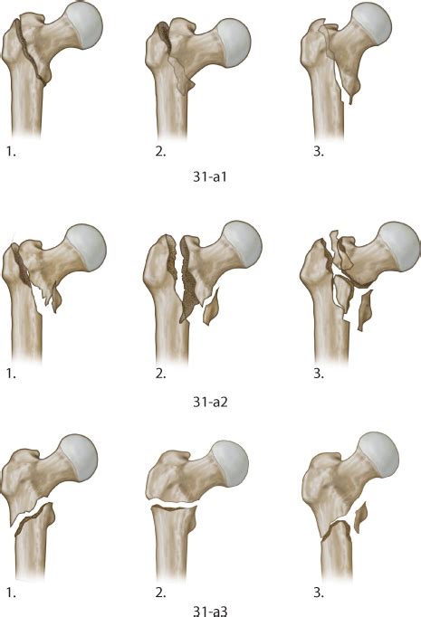 Extracapsular Proximal Femur Fractures Musculoskeletal Key