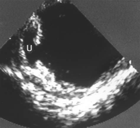 Diagnostic Imaging Of Thoracic Aortic Atherosclerosis Ajr