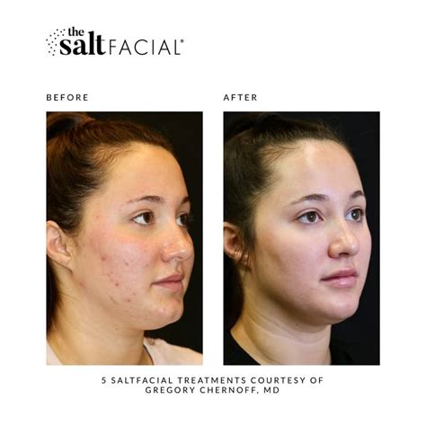 Salt Facial Skin Results Before And After Photos Salt Facial — Nyc Luxury Medical Spa