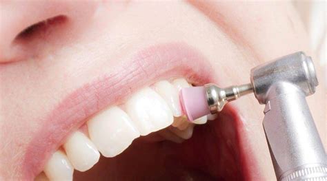 Profilaxis O Limpieza Dental Garzo Dental