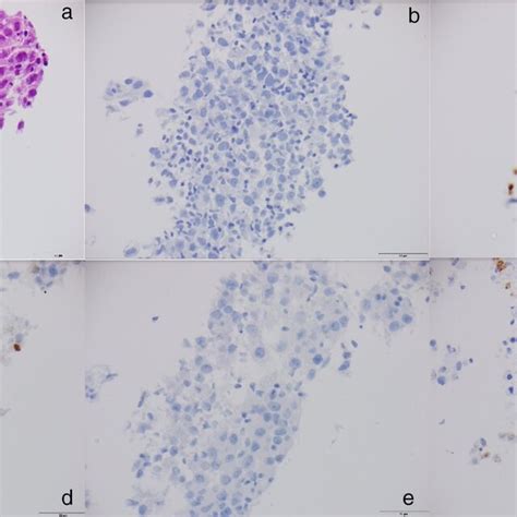 Liver histology for Case 1 demonstrating a hepatoid adenocarcinoma of ...