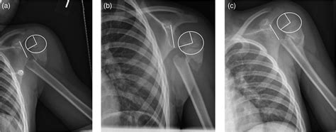 Radiographic Pseudosubluxation Of The Shoulder In Pediatric