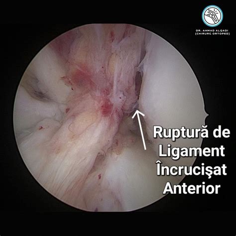 Tot ce trebuie să știi despre ruptura de Ligament Încrucișat Anterior