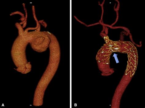 Endovascular Treatment Of Aortic Arch Aneurysm With A Single Branched