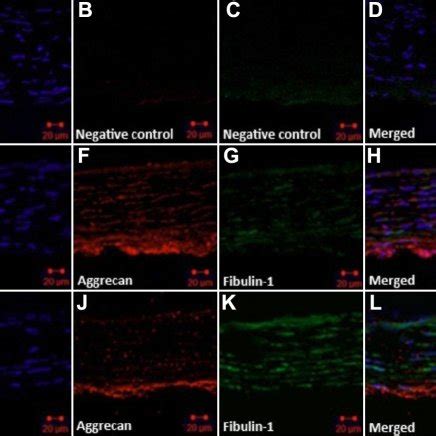 Expression Of Fibulin 1 In Human Scleral Fibroblasts HSFs Visualized