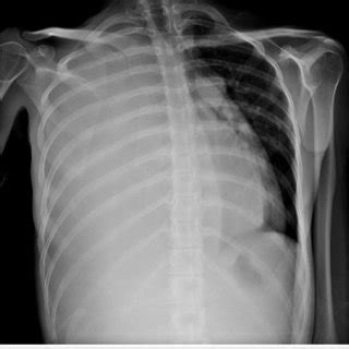 Tension Hydrothorax Chest Radiograph Demonstrates A Large Right