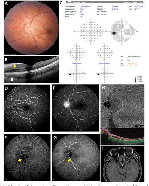 Figure 1 From Multimodal Imaging In Idiopathic Neuroretinitis With