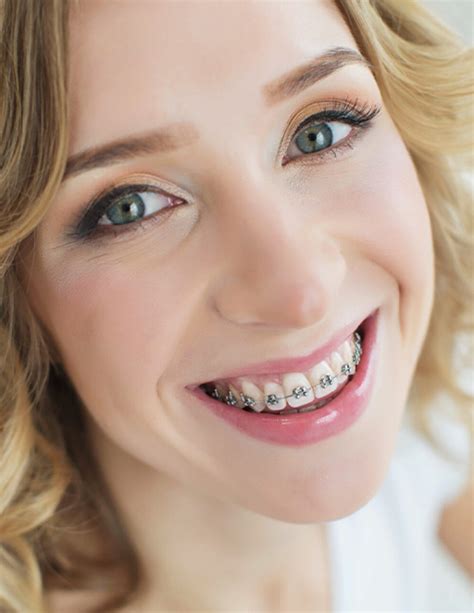 Traditional Braces Houston Tx Braces Near Me Hall Orthodontics And Tmj