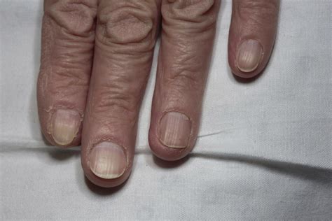 Nail Lichen Planus Mayo Clinic Proceedings