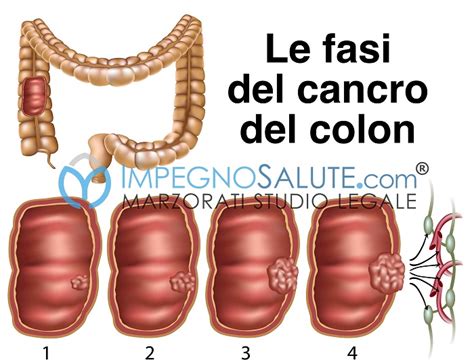 Errore Nella Diagnosi Del Tumore Al Colon E Risarcimento Danni