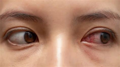 Fungal Infection In The Eye Symptom Treatment And Home Remedies