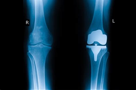 Protesi Al Ginocchio North West Orthopaedics