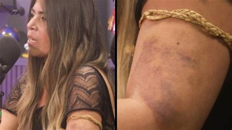 Bruna Surfistinha Mostra Hematomas E Diz Que Sofreu Agress Es De Seu Ex