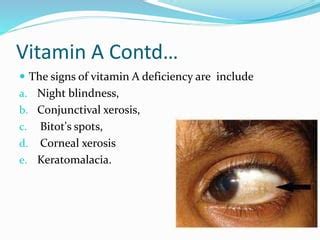 vitamin deficiencypptx