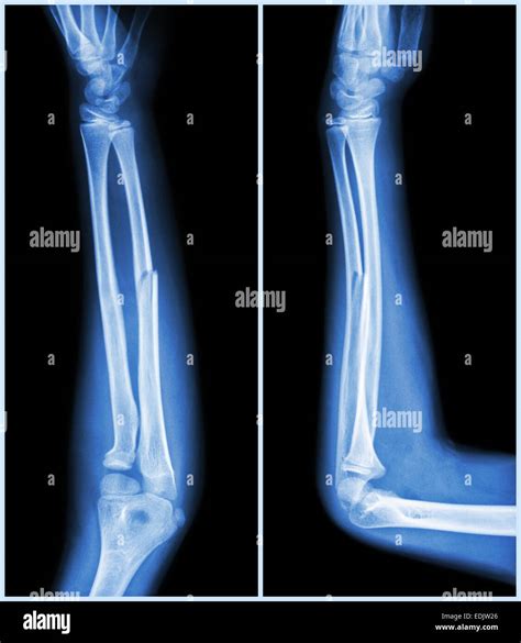 Human Arm Xray Hi Res Stock Photography And Images Alamy