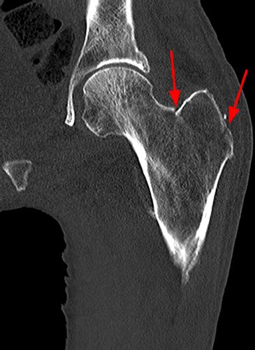 Serous Atrophy Radsource