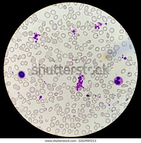 Blood Smear Showing Hypochromic Anemia Increased Stock Photo 2263989213 | Shutterstock