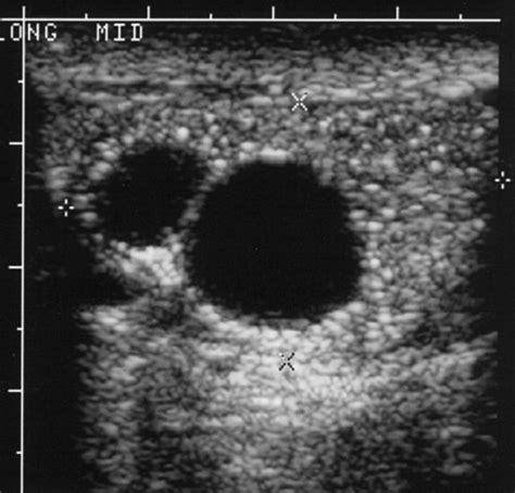 Benign Intratesticular Cystic Lesions Us Features Radiographics