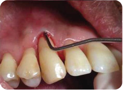 Punctual Periodontal Probing 12 Mm Periodontal Pocket Download