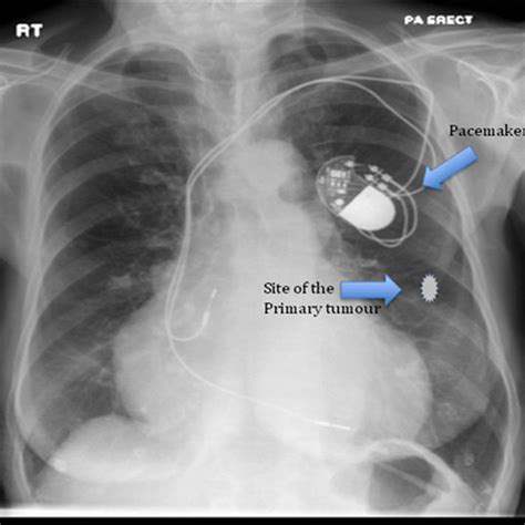 Pacemaker Chest X Ray