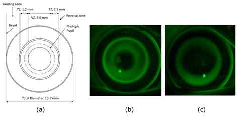 Jcm Free Full Text Multifocal Orthokeratology Versus Conventional Orthokeratology For Myopia