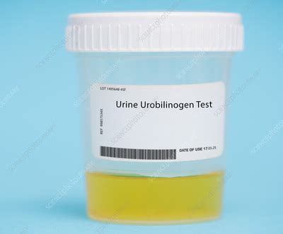 Urine urobilinogen test - Stock Image - F042/0396 - Science Photo Library