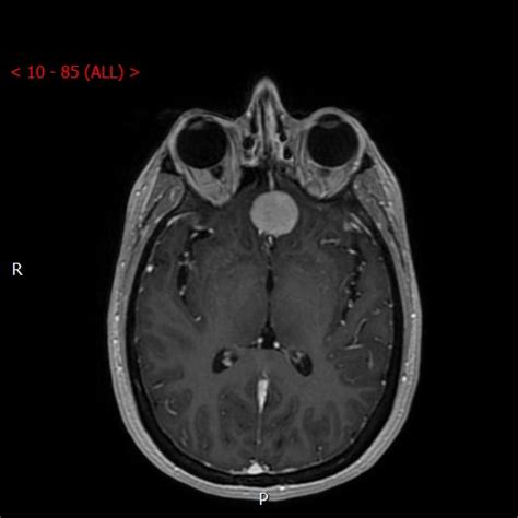 Olfactory Groove Planum Sphenoidale Meningioma Image