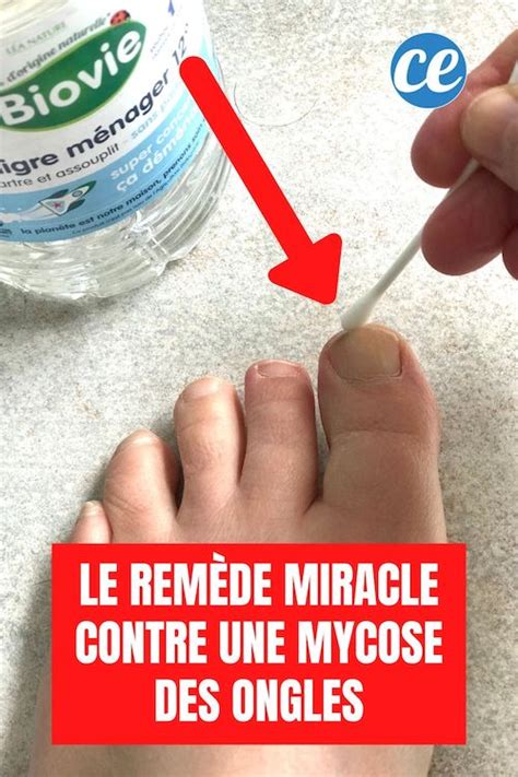 Traitement Pour Mycoses Ongles Pieds Oeil Probl Mes Cliniques The