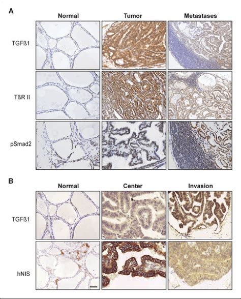 Figure From The Braf V E Oncogene Induces Transforming Growth