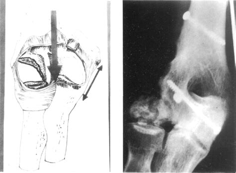 Figure 2 from Fracturas complejas del extremo distal del húmero