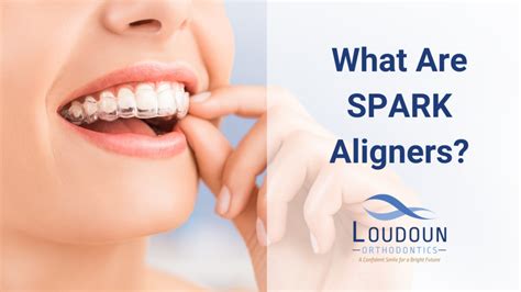 What Are Spark Aligners Loudoun Orthodontics