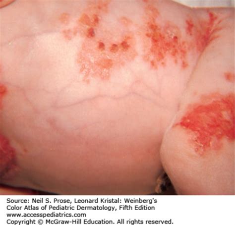 Herpes Simplex Virus 2 And Skin Discoloration Heidi Salon