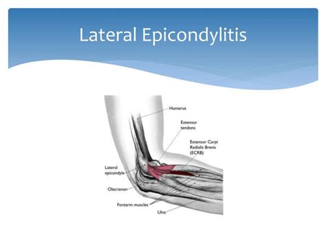 Ppt Prp For Lateral Epicondylitis Powerpoint Presentation Id 2258315