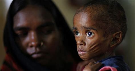 With 46.6 Million Malnourished & Over A Million Overweight Kids, India ...