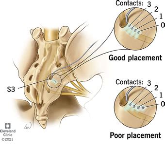 JU INSIGHT Intraoperative Predictors Of Sacral Neuromodulation