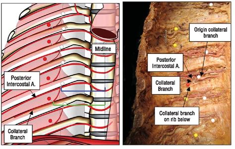 Posterior Intercostal Artery Tortuosity And Collateral Branch Points A