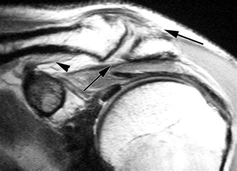 Coracoacromial Ligament Mri