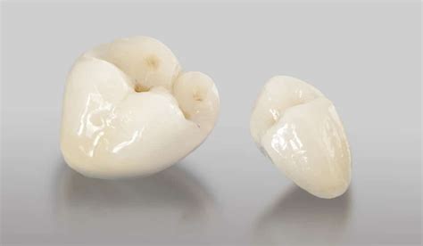 Tipos de coronas de porcelana - Clinica dental Julián Saiz