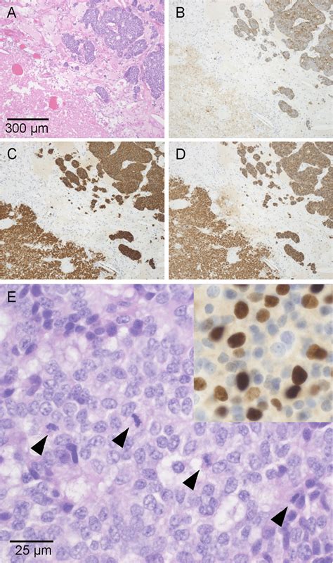 Large Cell Neuroendocrine Carcinoma Of Patient 4 AD Low Power