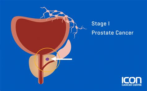 Stages Of Prostate Cancer