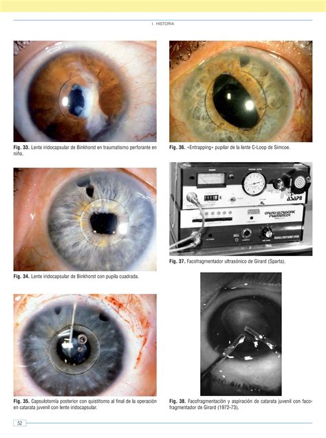 Libro Sobre Cirugia De Cristalino Y Catarata Ppt
