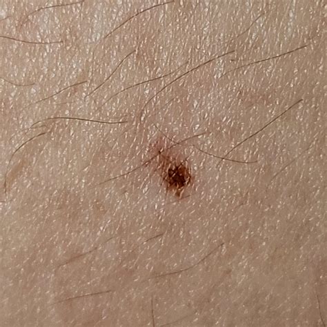 Is it normal to get new moles? : r/medical_advice