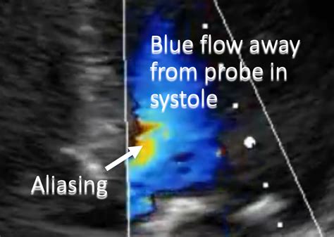 Artifacts In Ultrasound Doppler And Summary