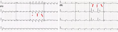 Illustration of two examples of ECG classes: abnormal ECG trace image ...