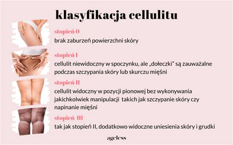 Cellulit W Pytaniach I Odpowiedziach Blog O Zdrowiu Blog O Urodzie