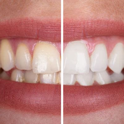 Teeth Whitening Applecross Mt Pleasant Wa Mount Pleasant Dental Centre