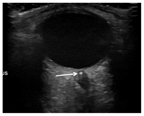 Ultrasound Of Orbital Cavity With A Retrobulbar Spot Sign Arrow In Download Scientific